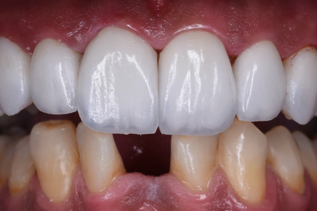 E-Max Veneers in Turkey